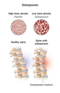 Účinky osteoporózy na chrbticu - fraktúry vplyvom kompresie.